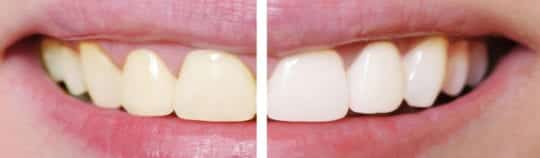 Teeth Whitening Myths and Facts