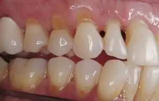 Gum Recession