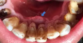 Periodontal Abscess