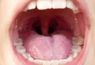 Tonsil Stones