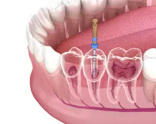 root canal procedure