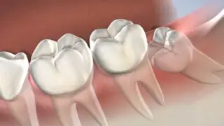 Wisdom tooth