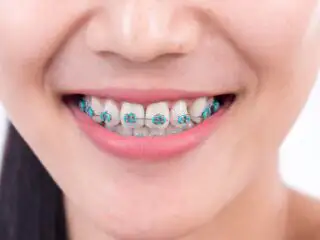 braces