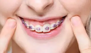 braces