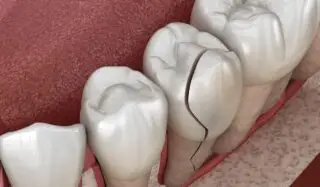 crack in tooth