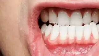 bleeding gums