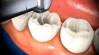 root canal