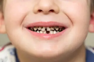 decayed teeth