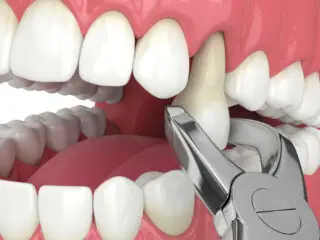 tooth extraction