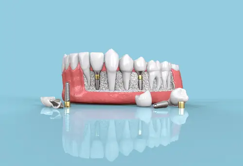 Dental Implant
