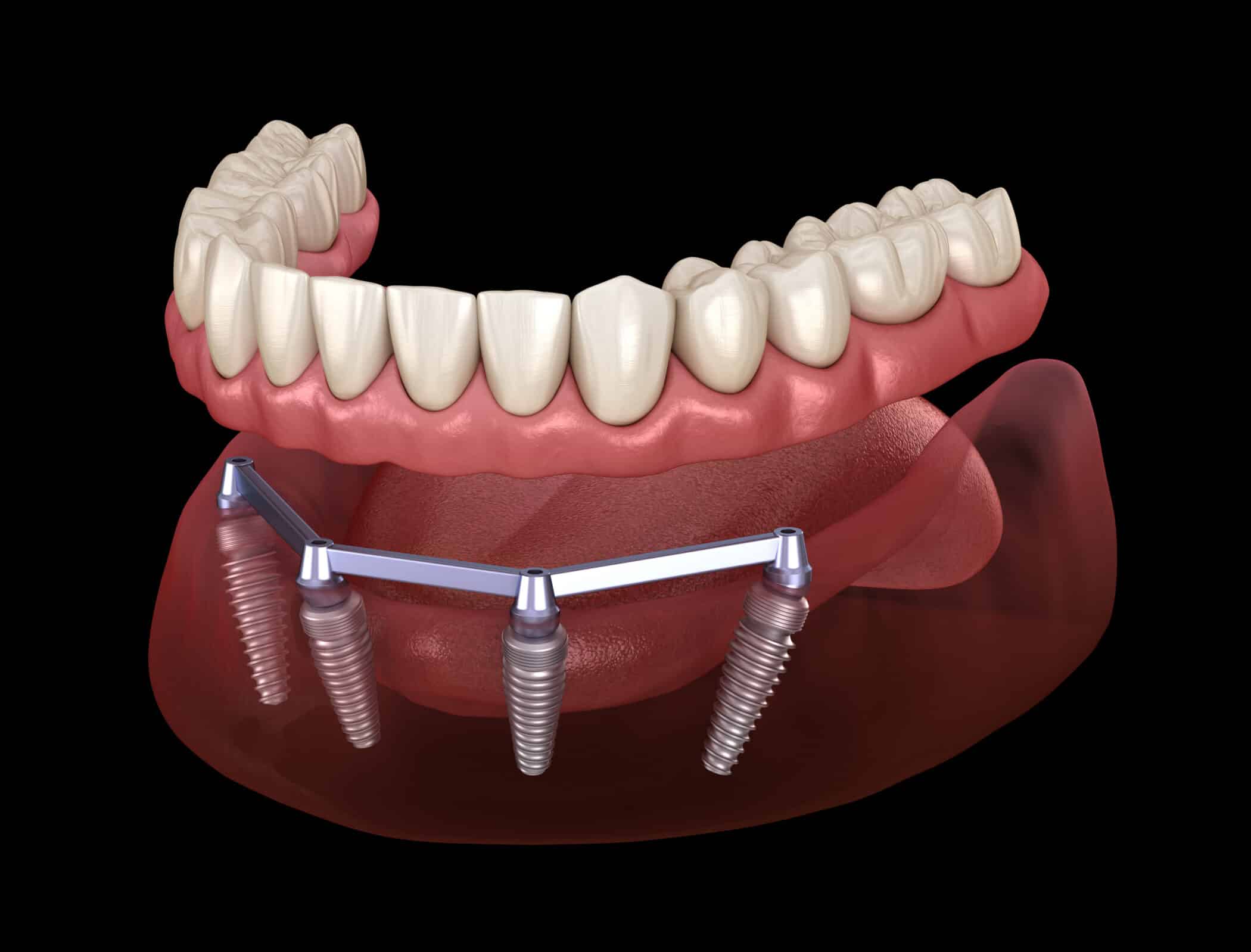 All on 4 Dental Implants in Houston, TX