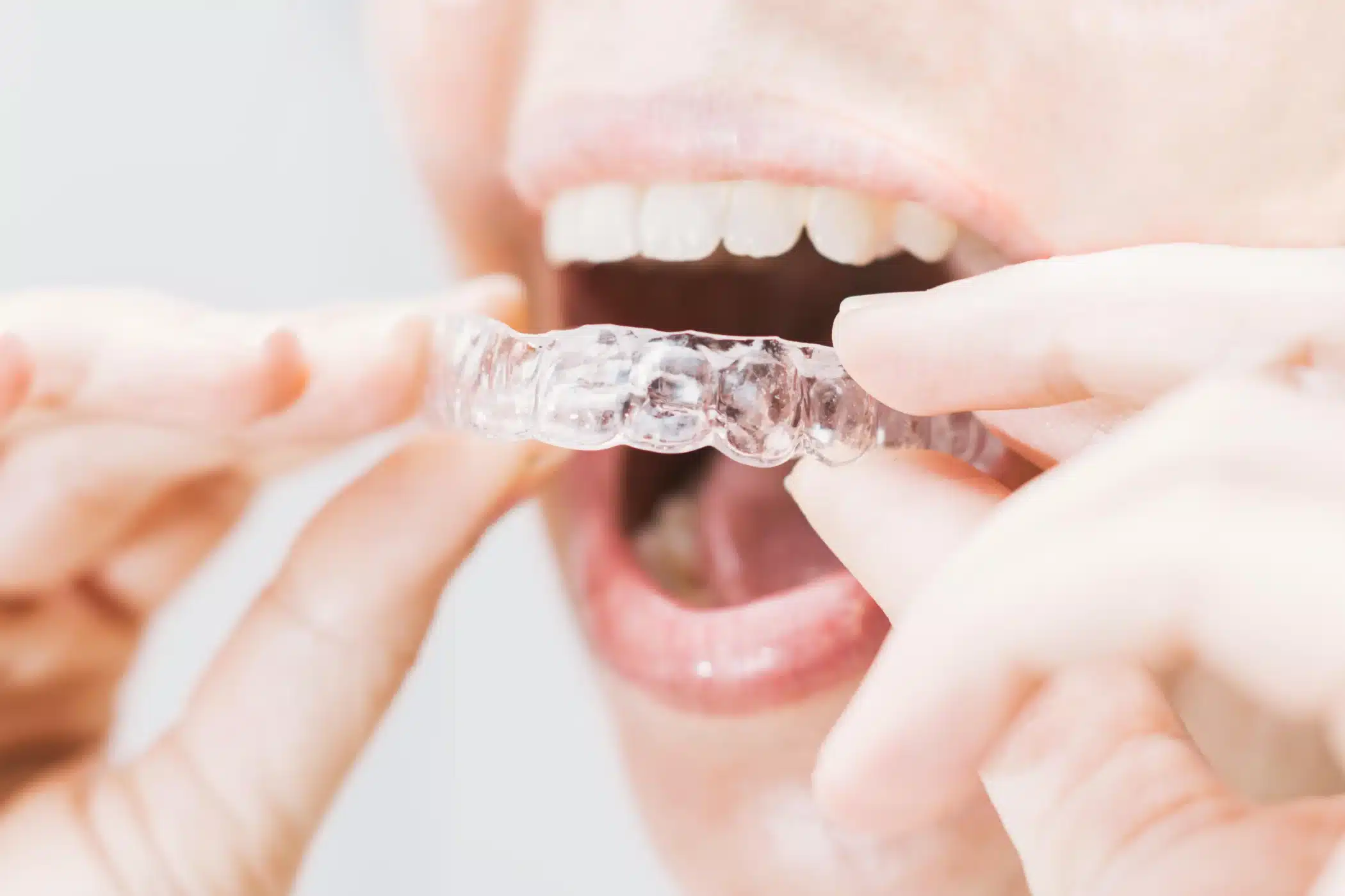 Can Invisalign Fix Crossbite?