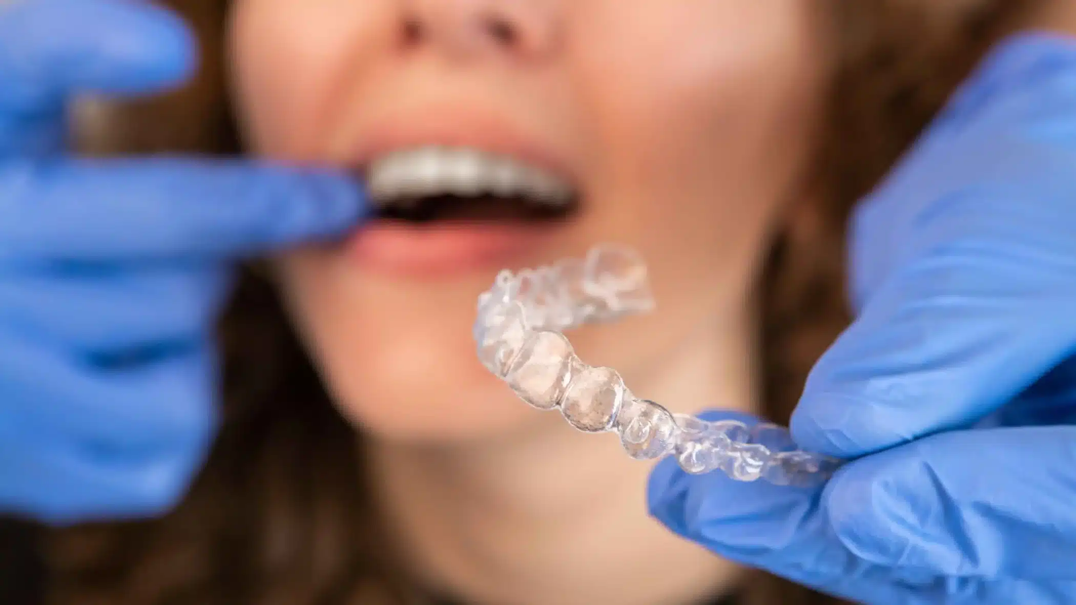 Can Invisalign fix Teeth Gaps