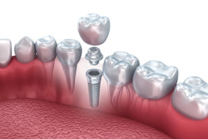Dental Implant diagram
