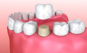 dental crown diagram