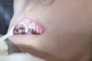 Image showing a lost implant on a patient