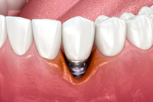 Peri-implantitis with visible gingiva recession. Medically accurate 3D illustration.